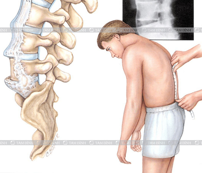 Biến chứng của viêm cột sống dính khớp
