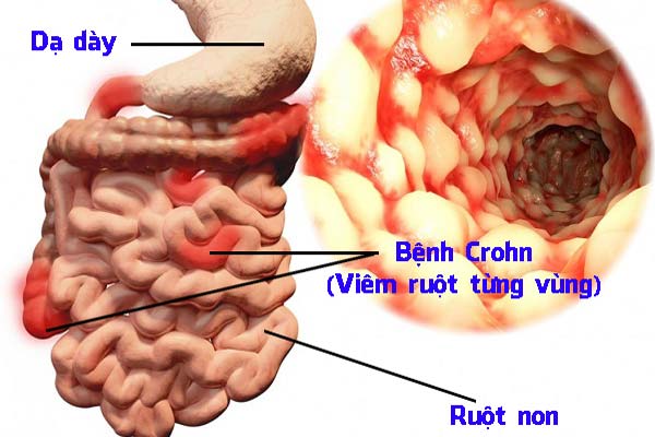 crohn viêm ruột từng vùng