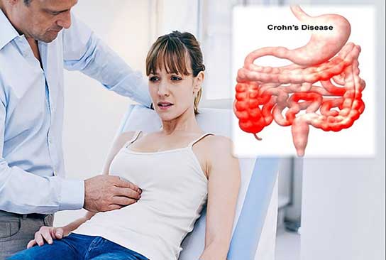 Điều trị bệnh Crohn