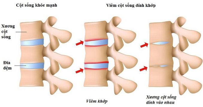 Viêm cột sống dính khớp là bệnh gì?