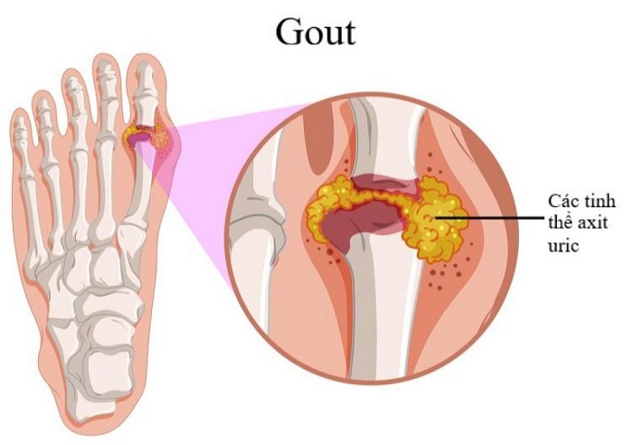 Bệnh gout (gút) có di truyền không
