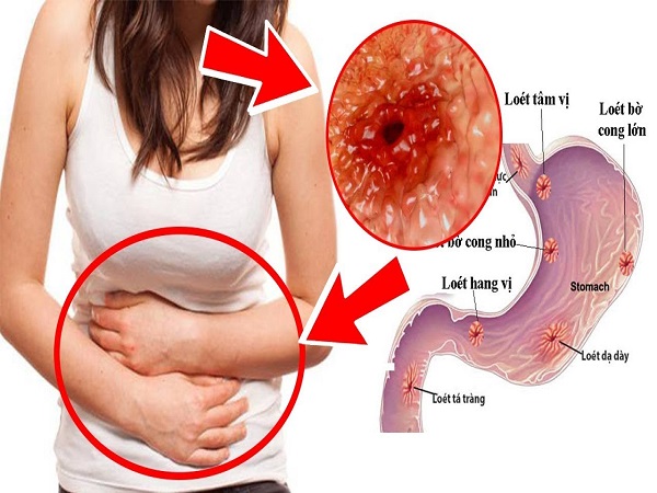 Viêm loét dạ dày gây đi đi ngoài phân sống