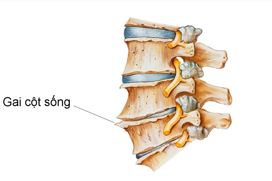 Gai cột sống là gì