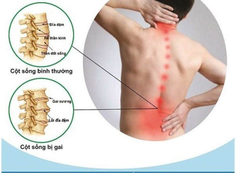 Biểu hiện của bệnh gai cột sống thắt lưng
