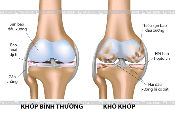 Tổng quan bệnh khô khớp gối