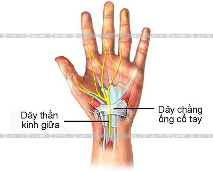 Hội chứng ống cổ tay gây cứng khớp ngón tay