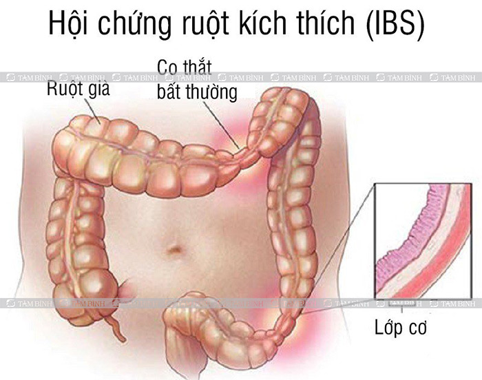hội chứng ruột kích thích gây đau bụng âm ỉ