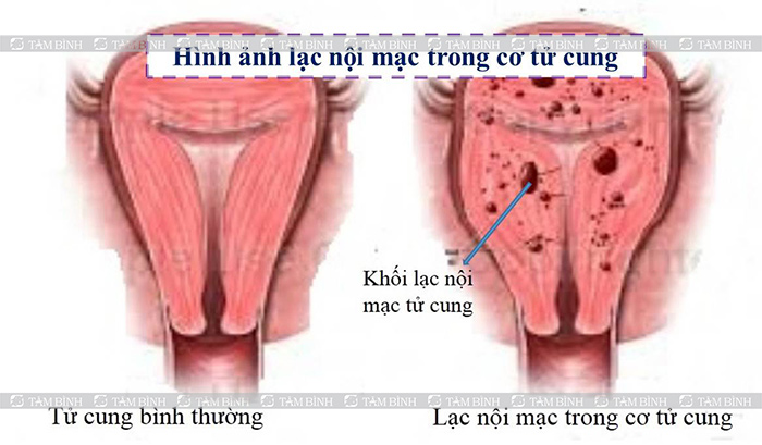 Lạc nội mạc tử cung gây đau bụng âm ỉ