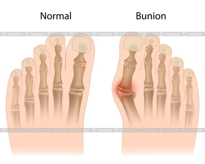 bệnh bunion