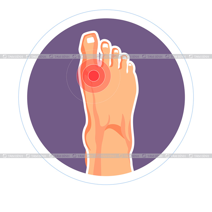 Có những biện pháp phòng ngừa nào để tránh viêm khớp ngón chân cái?
