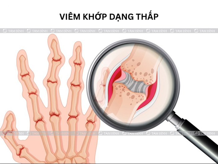 Bệnh khớp khiến ngón tay bị sưng