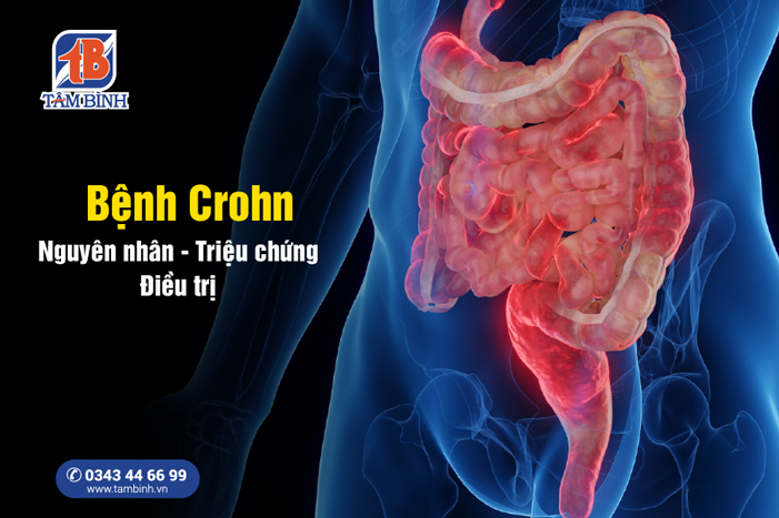 bệnh crohn là gì