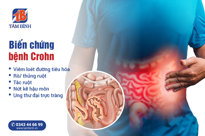 biến chứng nguy hiểm của bệnh crohn