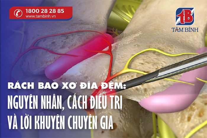 Rách bao xơ đĩa đệm là gì