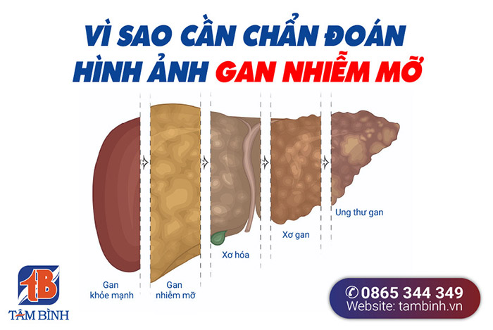 Viêm gan B là gì Cần phải xét nghiệm những gì để phát hiện Viêm gan B