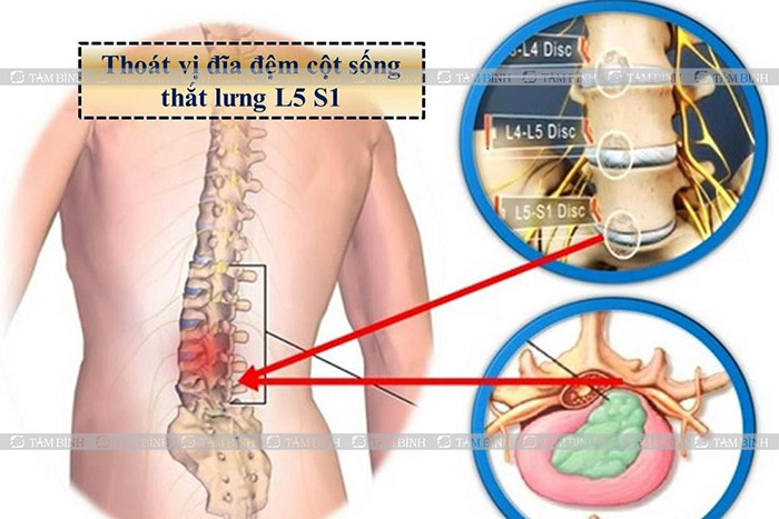 Thoát vị đĩa đệm cột sống thắt lưng L5-S1 gây đau xương cụt