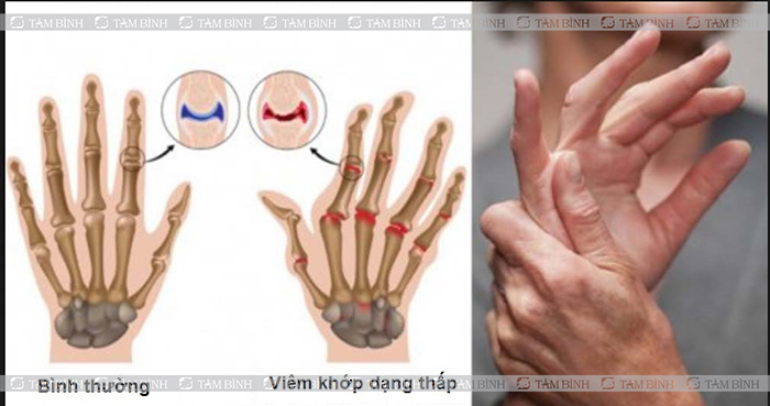 Tế đầu ngón tay có thể do viêm khớp dạng thấp