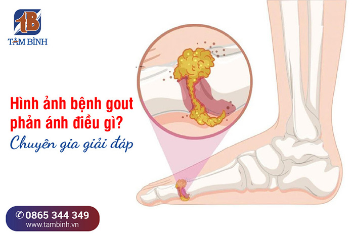 Tìm hiểu căn bệnh xquang gout và ảnh hưởng của nó