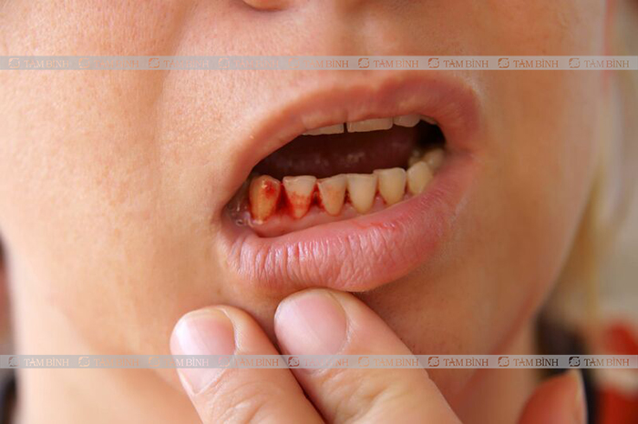 Cẩn thận với biểu hiện chảy máu chân răng, mũi