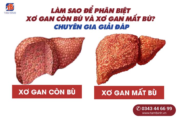 phân biệt xơ gan còn bù và mất bù