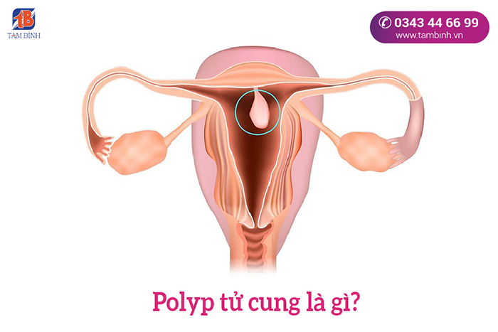 Polyp tử cung là gì