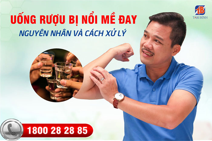 uống rượu bia bị nổi mề đay, mẩn ngứa