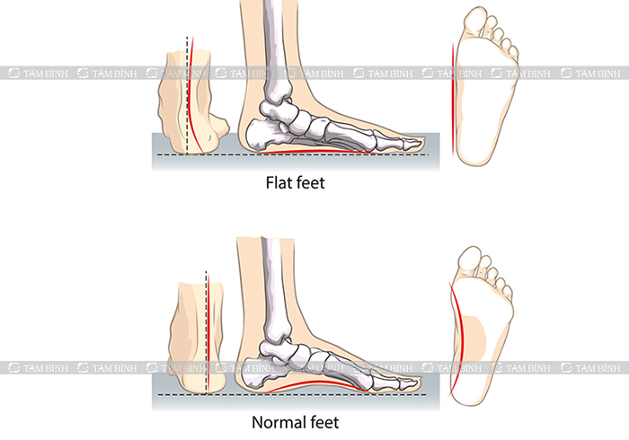 Hệ quả của hội chứng bàn chân bẹt gây viêm bao hoạt dịch