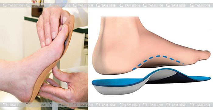 Sử dụng dụng cụ hỗ trợ điều trị viêm bao hoạt dịch ngón chân cái