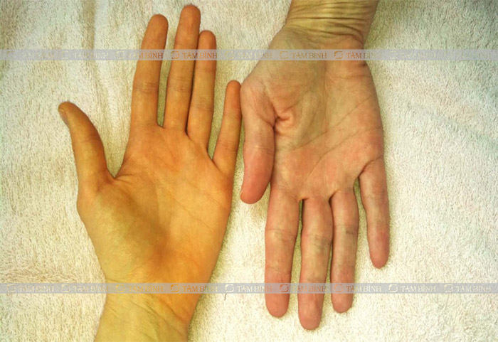 Hầu hết những người có chỉ số bilirubin cao thường có biểu hiện vàng da