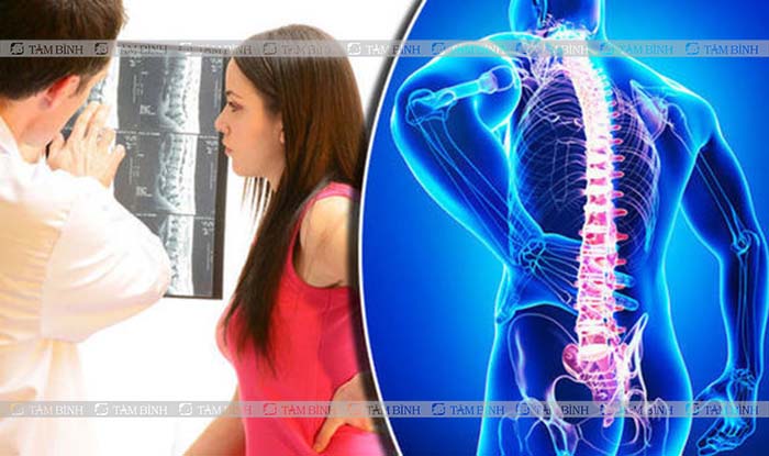 Chụp X quang thường được bác sĩ chỉ định trong chẩn đoán đau cột sống lưng