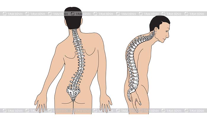 Cong vẹo cột sống cũng là nguyên nhân khiến bạn dễ bị đau thắt lưng dưới