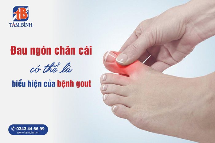 Đau khớp ngón chân cái có thể là biểu hiện của bệnh gout
