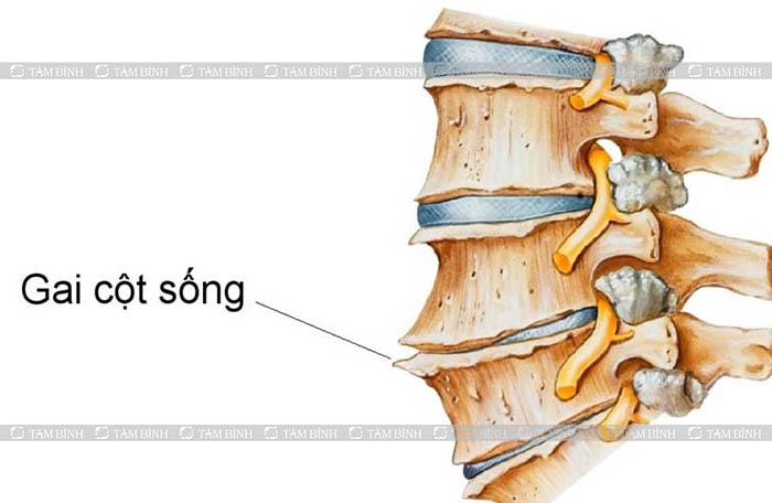 Gai cột sống có thể gây đau nhức lưng