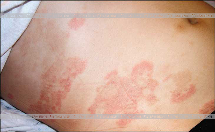 Lupus ban đỏ hệ thống cũng thuộc bệnh viêm khớp