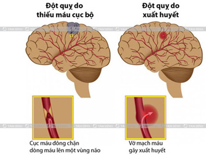 Rối loạn vận mạch não có nguy hiểm không