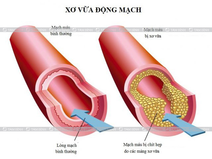 Nguyên nhân gây rối loạn vận mạch não