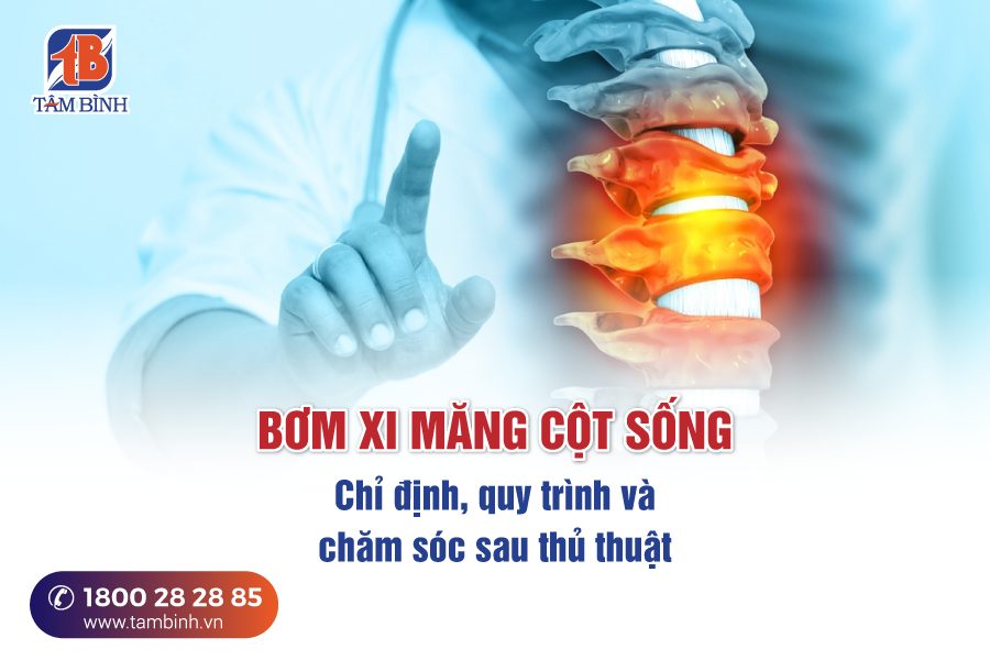 bơm xi măng cột sống