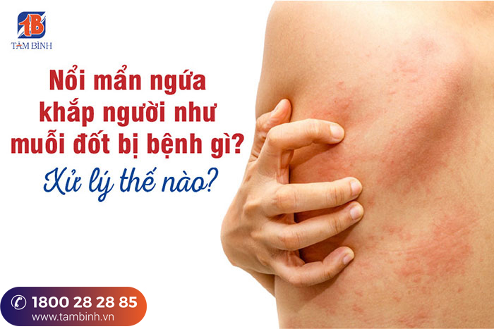 Nổi mẩn ngứa như muỗi đốt