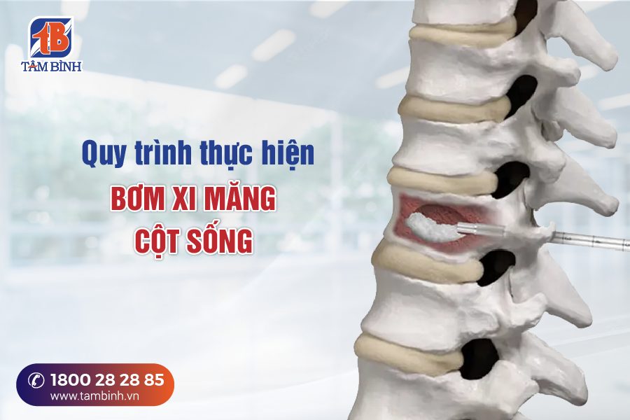 quy trình bơm xi măng cột sống