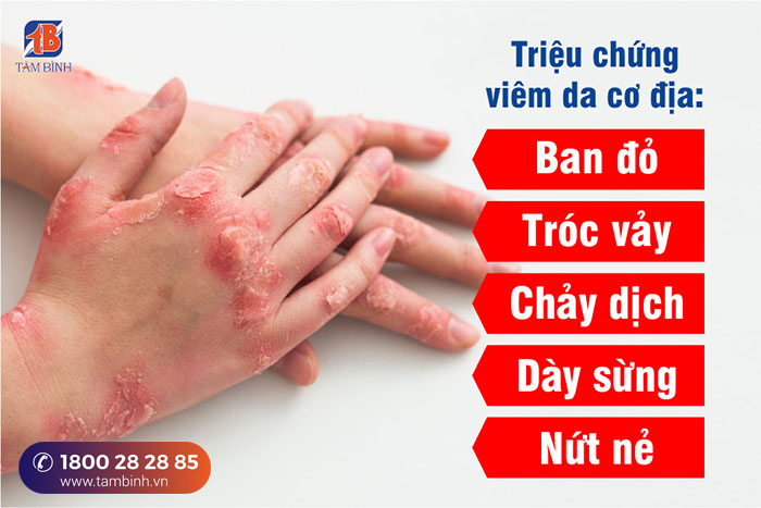 Triệu chứng viêm da cơ địa