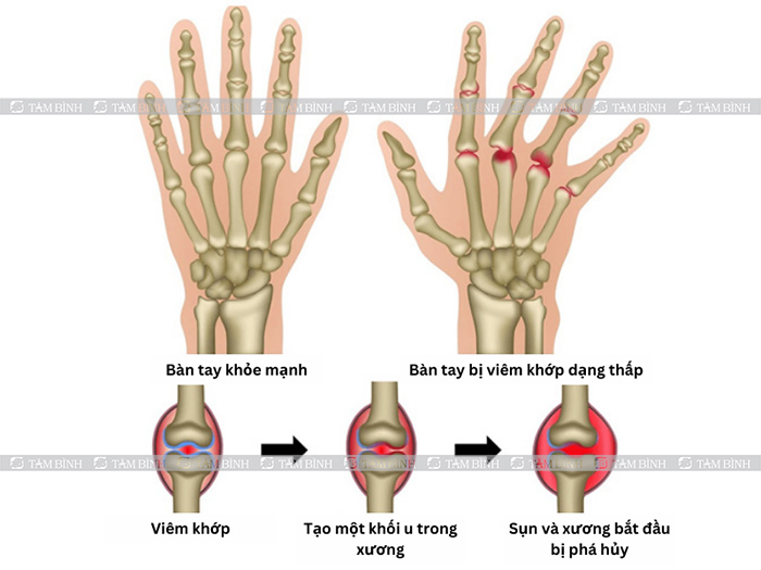 Hệ quả của các bệnh lý xương khớp gây tràn dịch khớp