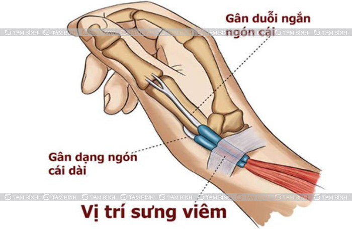 Sưng tấy do viêm bao gân De Quervain