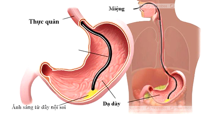 chẩn đoán trào ngược dạ dày gây đau lưng trên