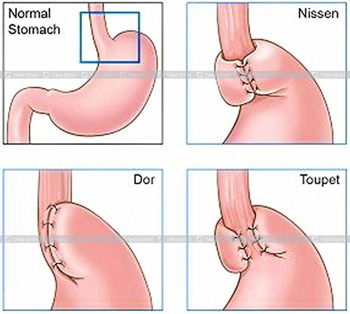 phẫu thuật chữa trào ngược dạ dày thực quản