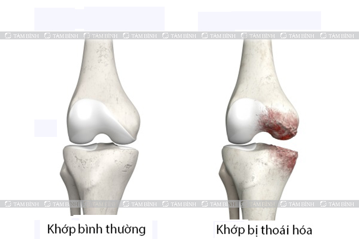 Hệ quả của các bệnh lý khác  gây đau buốt trong xương ống chân