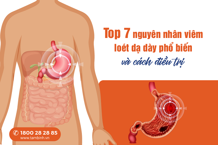 nguyên nhân viêm loét dạ dày