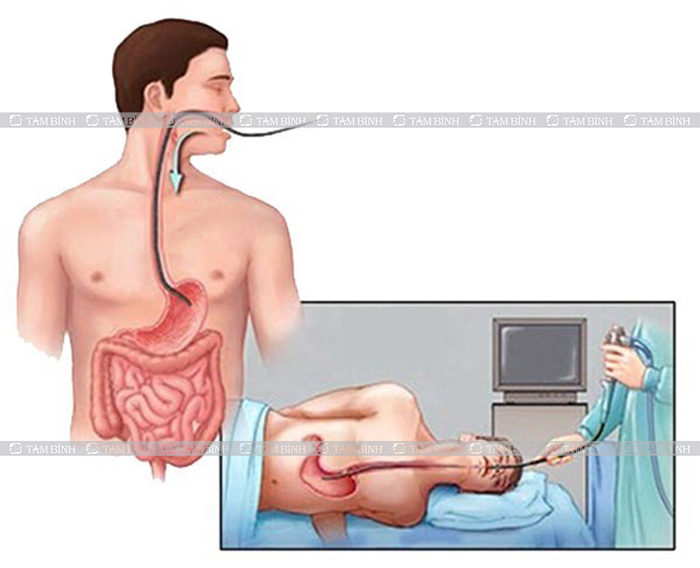 Nội soi dạ dày - Phương pháp chẩn đoán bệnh phổ biến