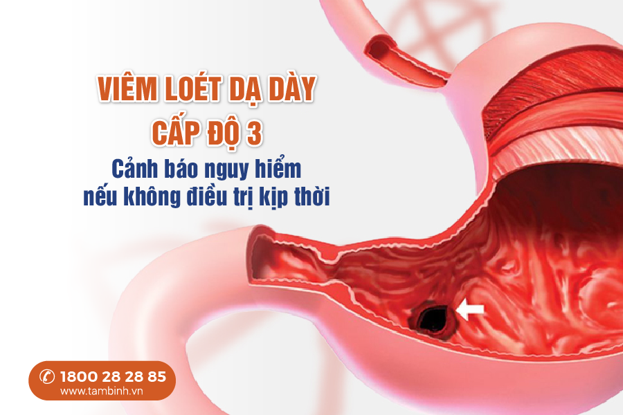 viêm loét dạ dày cấp độ 3