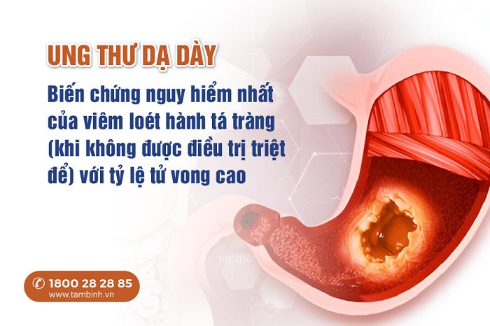 Viêm loét hành tá tràng có nguy hiểm không? Cách nhận biết và xử lý sớm