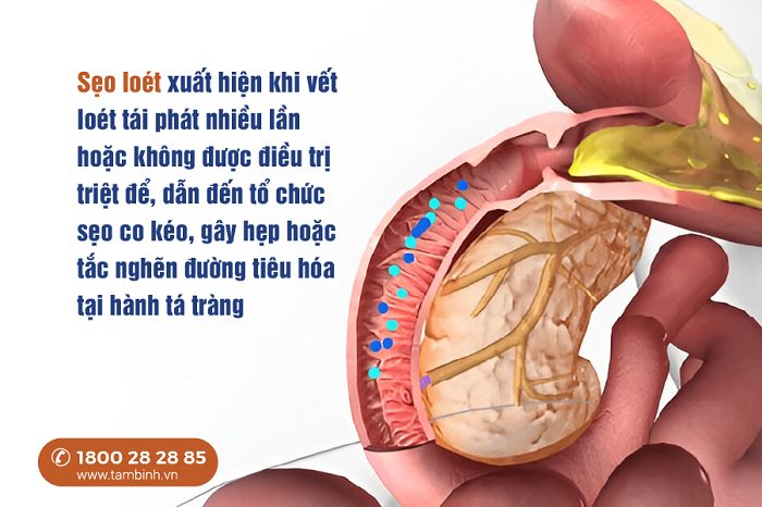 Sẹo loét hành tá tràng có nguy hiểm không? Giải đáp chi tiết